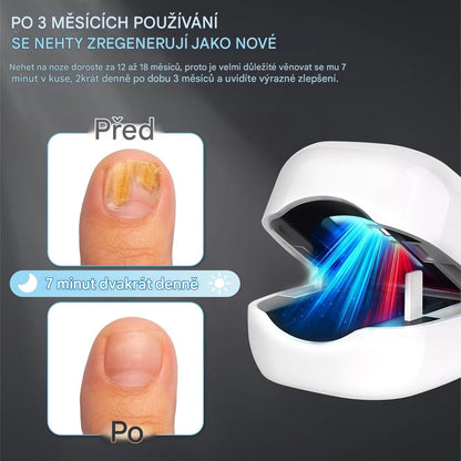 Elthivo Laserové LED zařízení pro léčbu nehtové mykózy