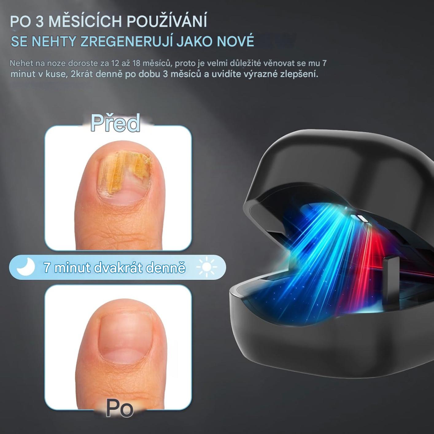 Elthivo Laserové LED zařízení pro léčbu nehtové mykózy